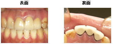 審美歯科 白い歯の種類