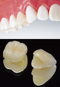 審美歯科 白い歯の種類