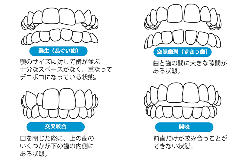 当該インビザラインの治療対象